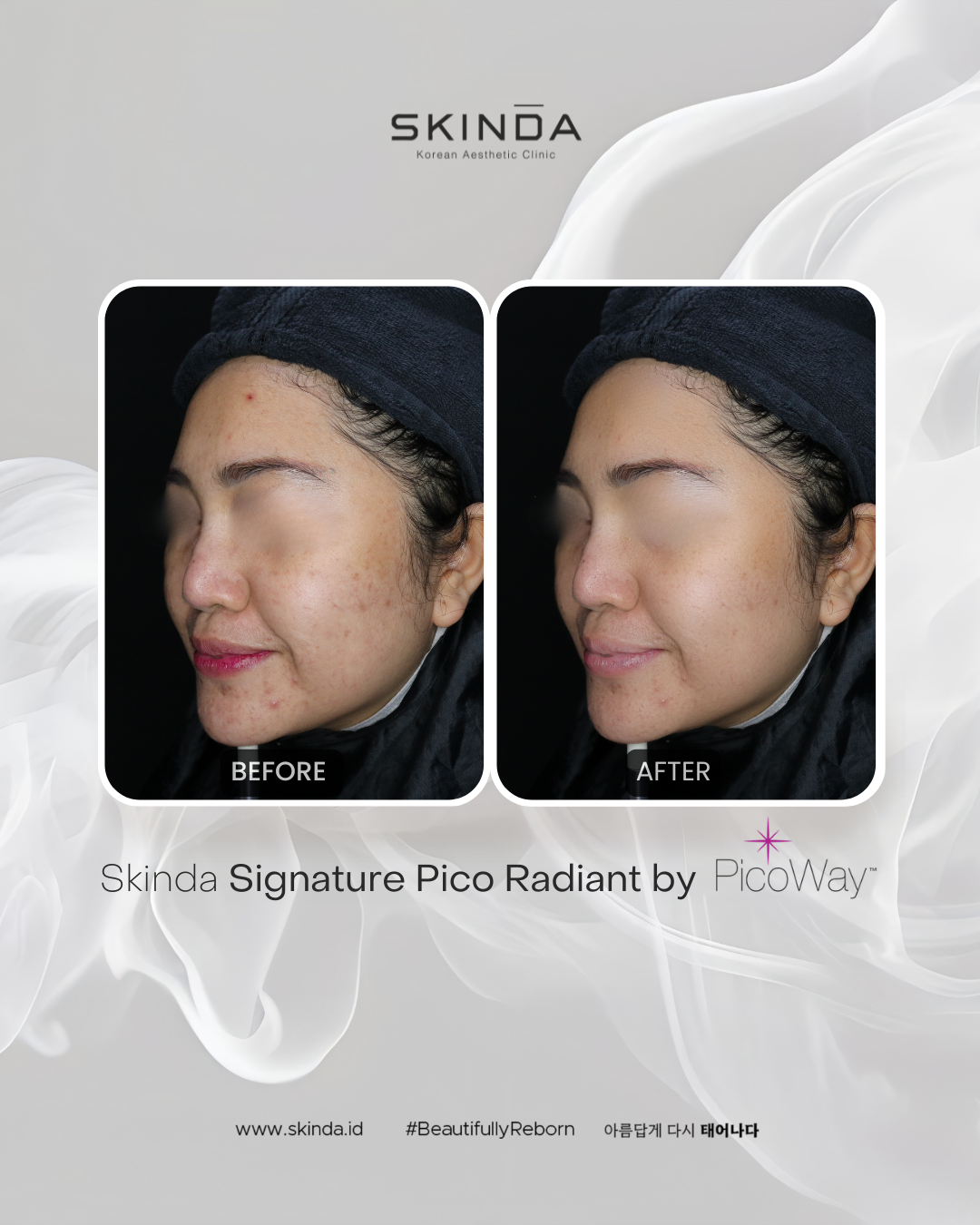 SKINDA SIGNATURE PICO RADIANT by Picoway